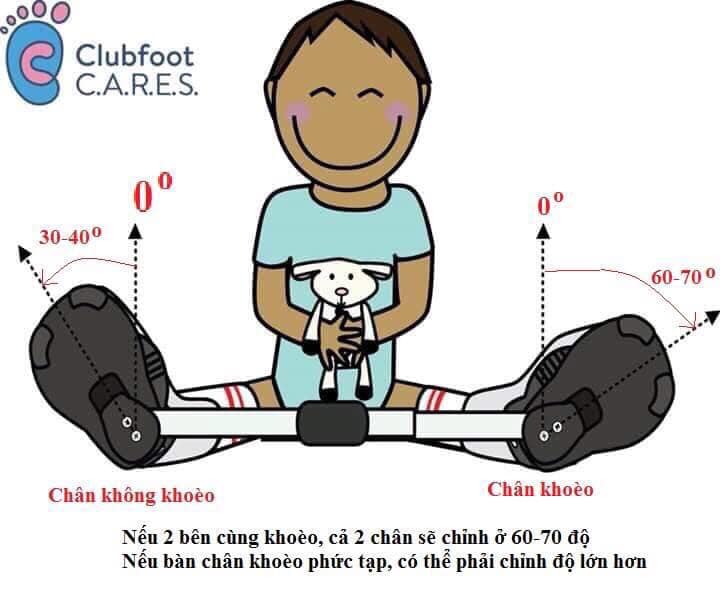 Dị tật bàn chân khoèo. Nguyên nhân và biểu hiện của dị tật bàn chân khoèo